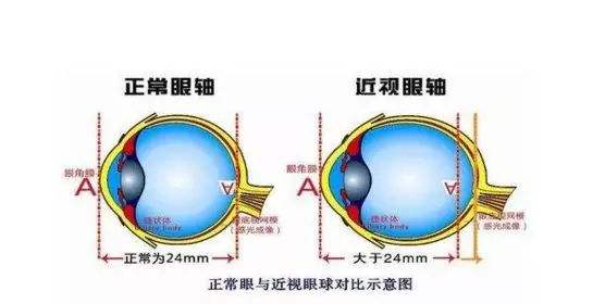 近视手术后能改善眼睛变形吗？