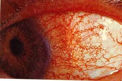 普瑞眼科专家提醒：战“疫”时期这三类眼疾要注意!