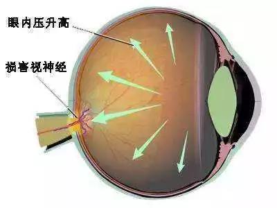 普瑞眼科专家提醒：战“疫”时期这三类眼疾要注意!