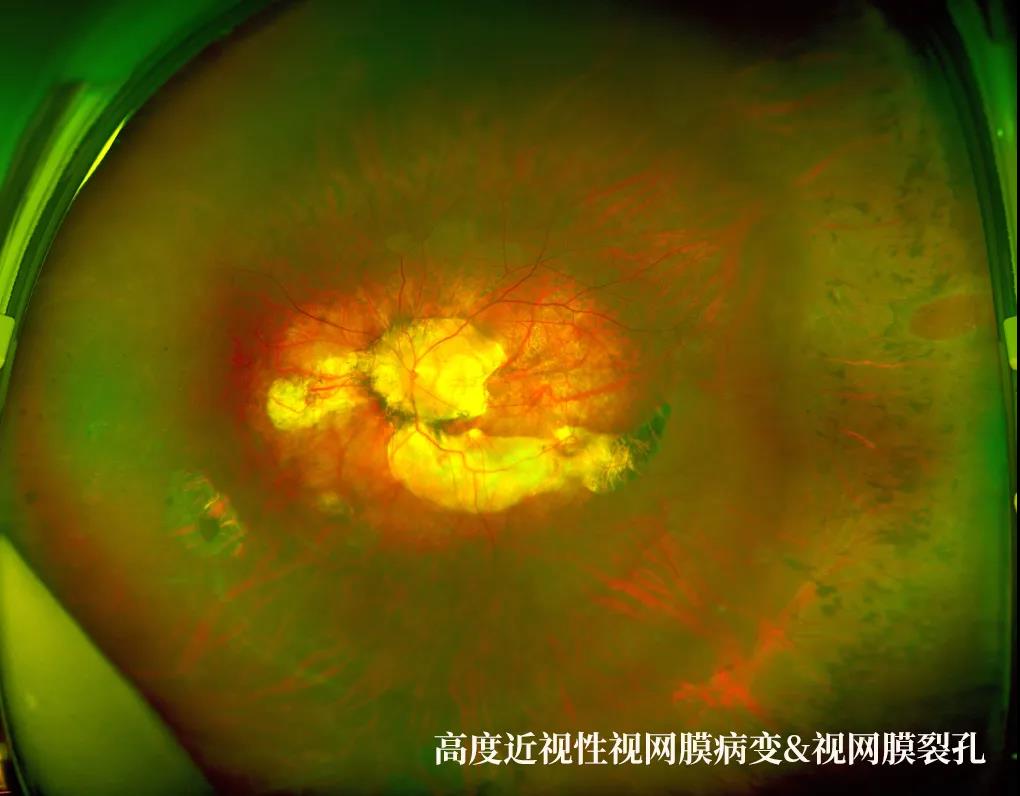 又快又准还免散瞳的眼底检查神器——欧堡