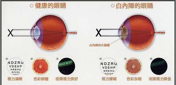 白内障术前术后注意事项